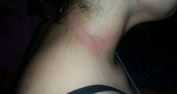 Be Careful: This Girl Suffered Terrible Burns Due To One Object You Also Use Every Single Day!