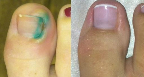 ingrown-toenails-treatment-aftercare-sussex-foot-centre